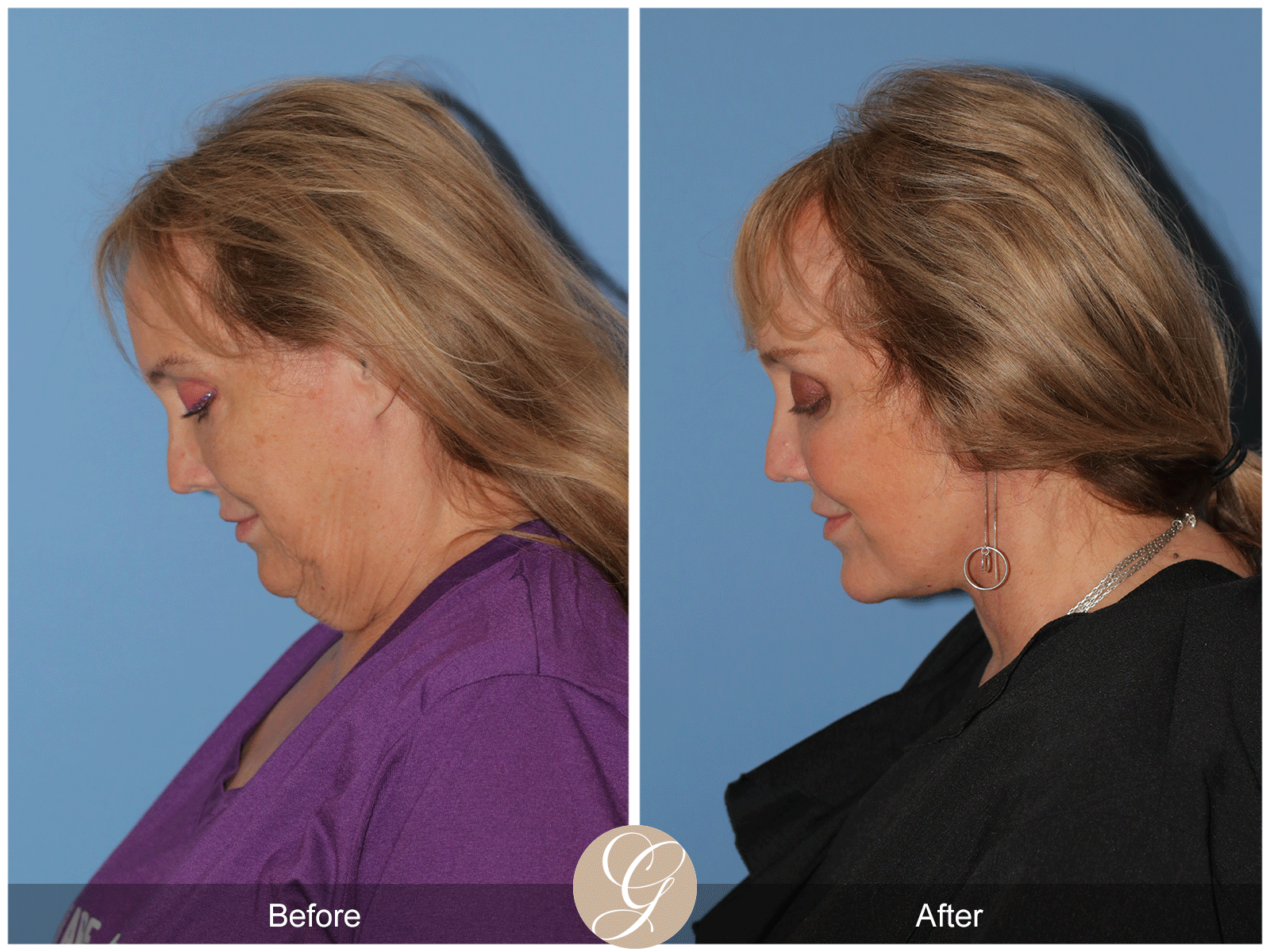 Deep Plane Facelift Case 48 Image