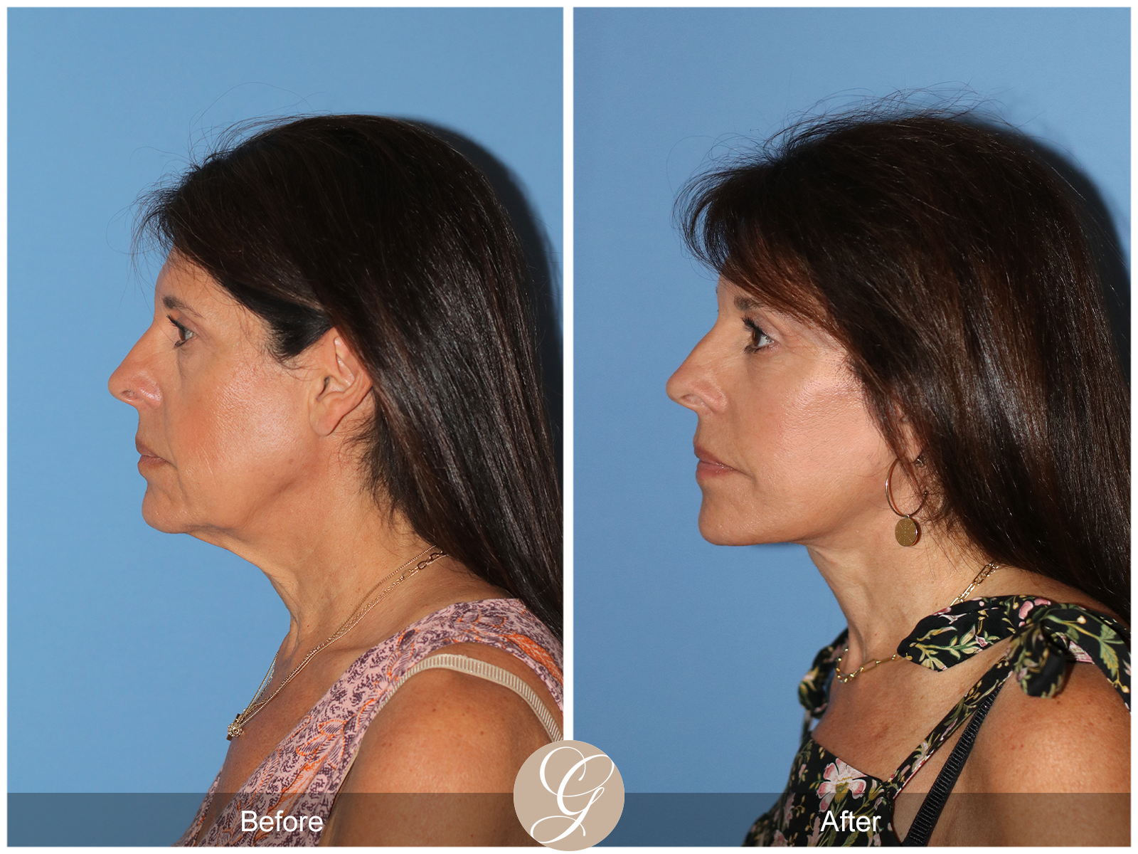 Deep Plane Facelift Case 32 Image