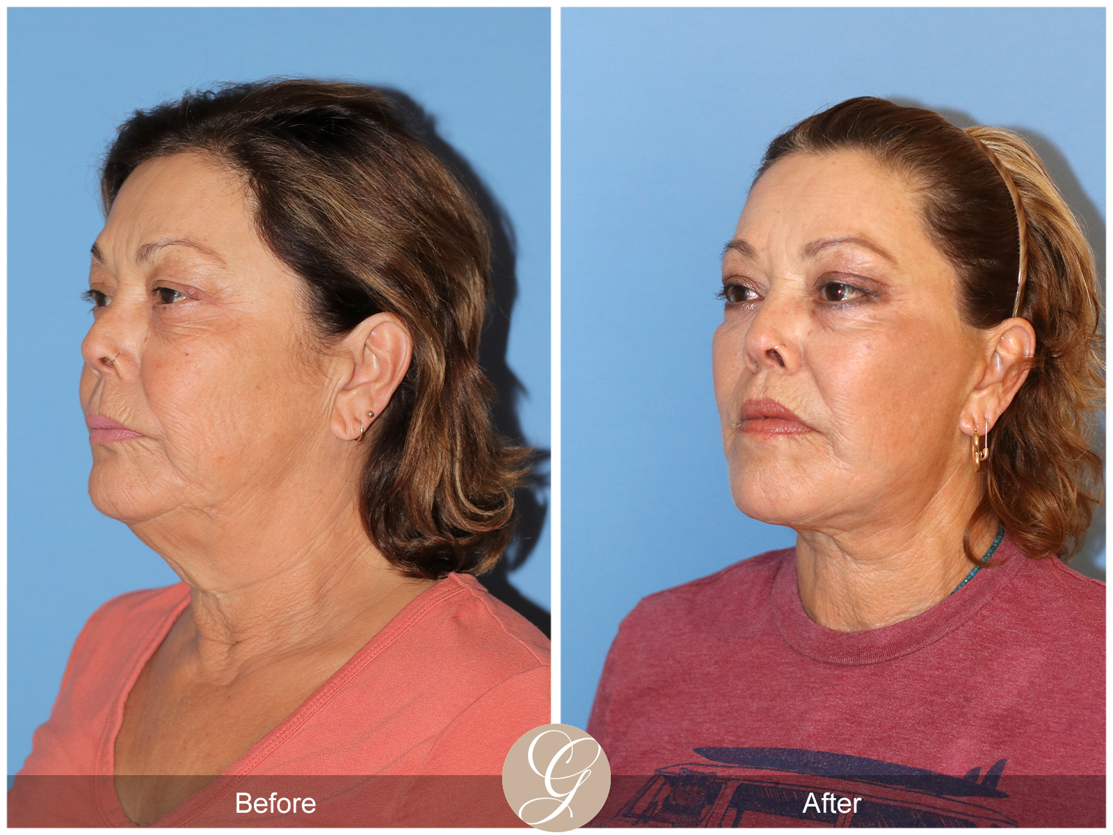 Deep Plane Facelift Case 37 Image