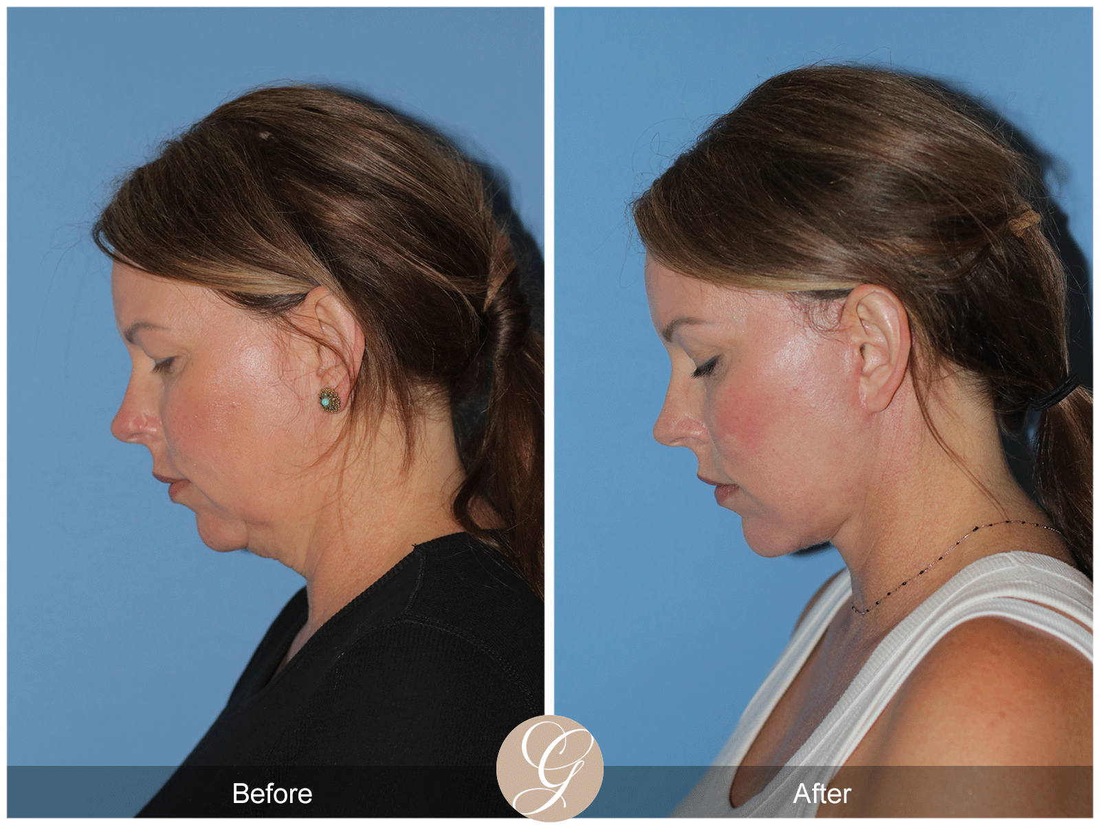 Deep Plane Facelift Case 33 Image