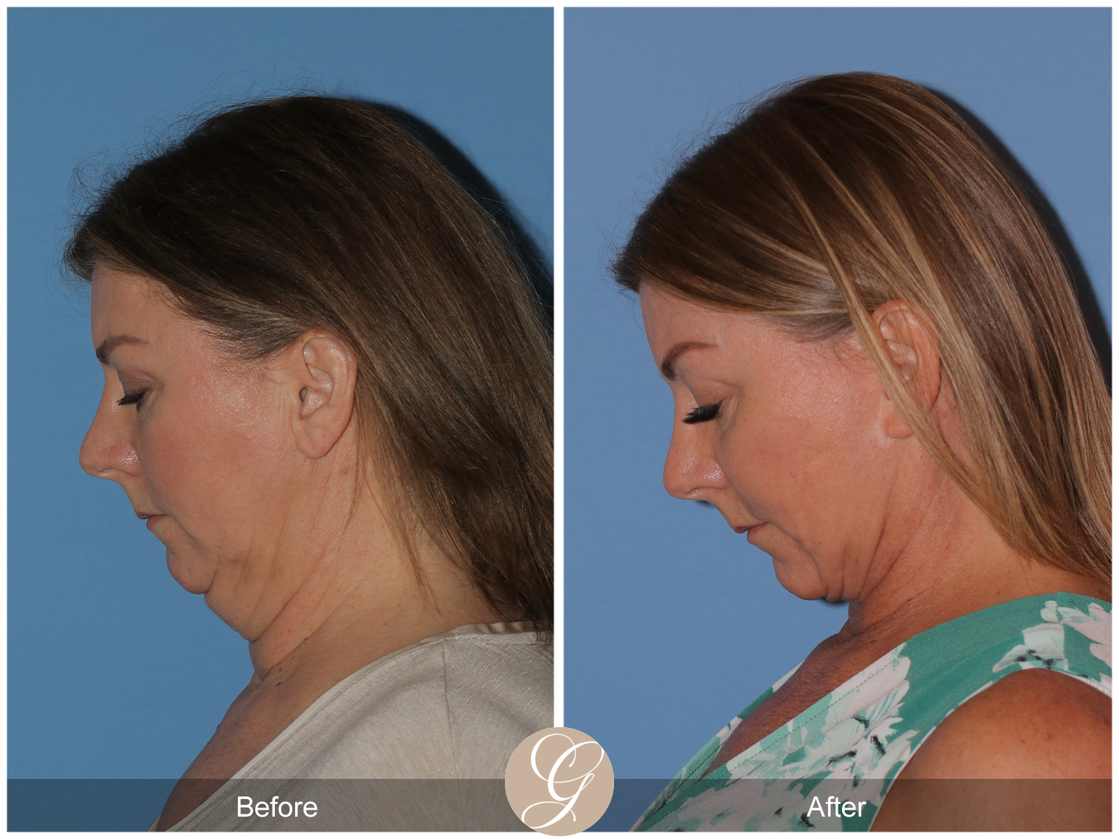 Preservation Deep Plane Facelift Case 37 Image