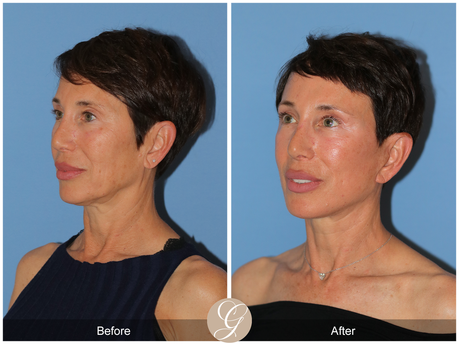 Deep Plane Facelift Case 47 Image