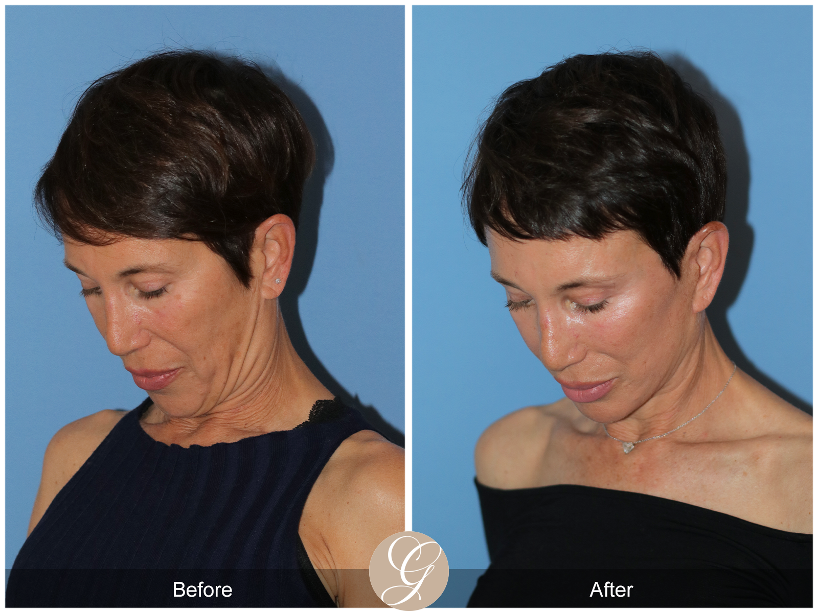 Deep Plane Facelift Case 47 Image