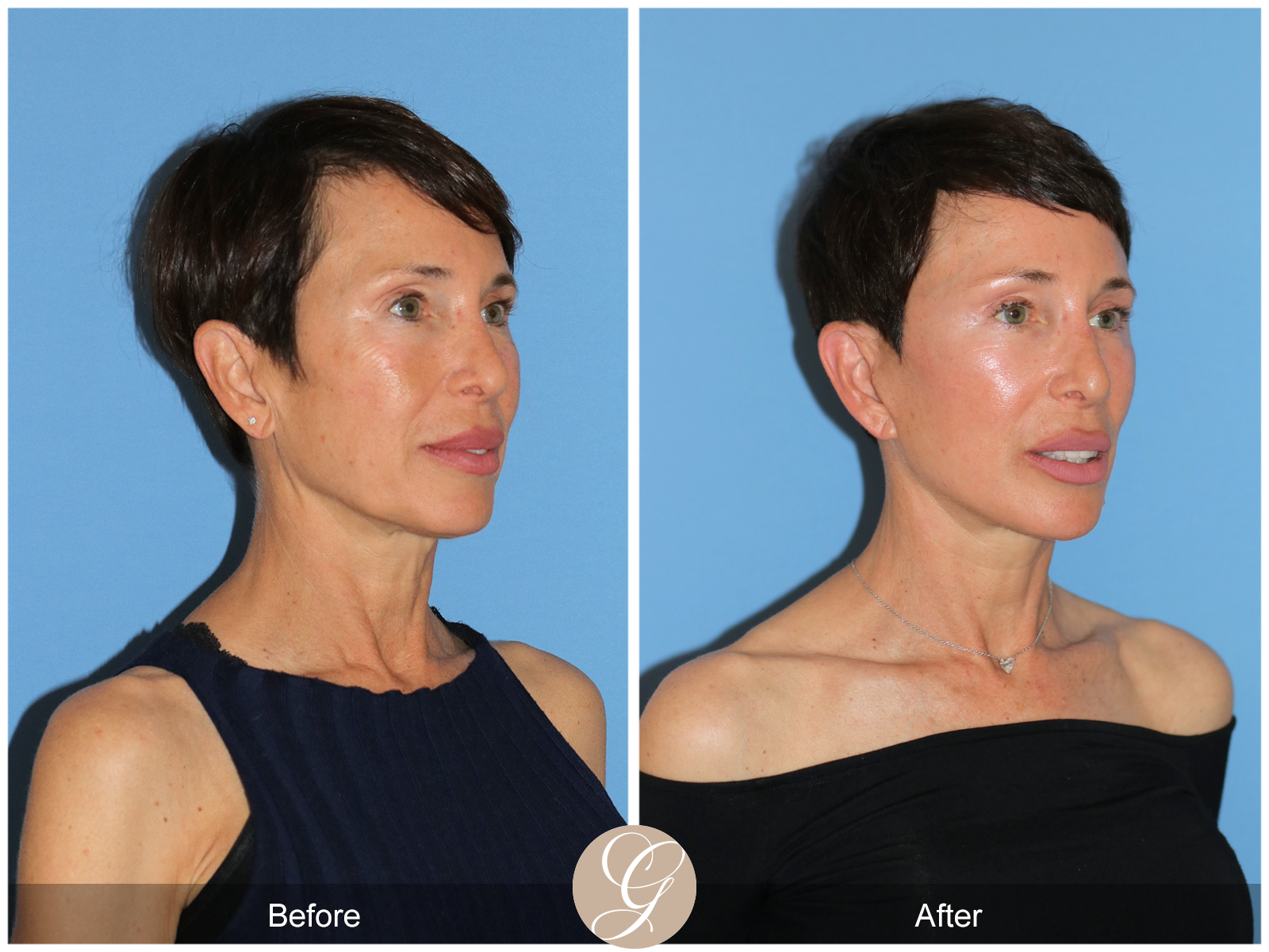 Deep Plane Facelift Case 47 Image