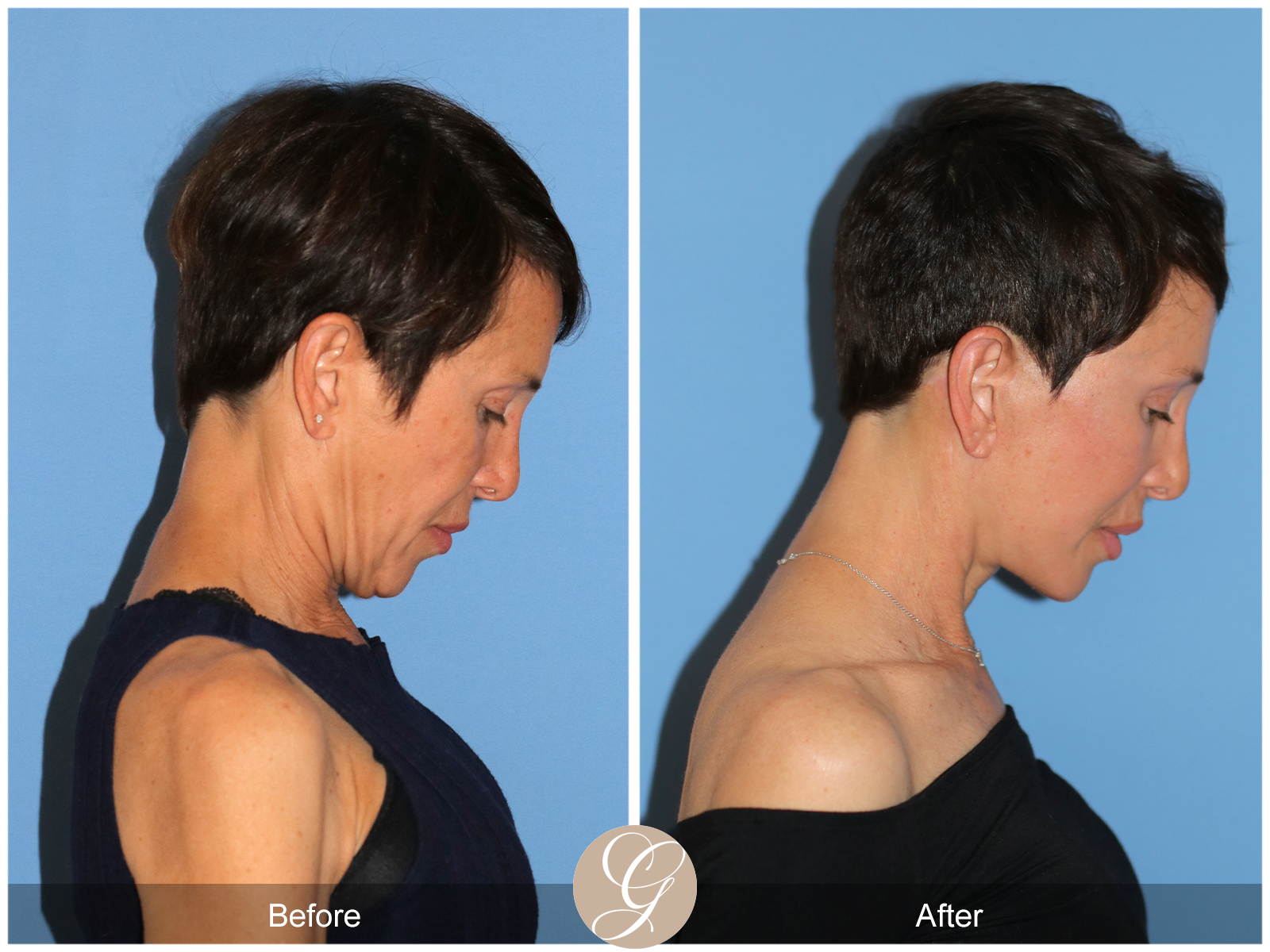 Deep Plane Facelift Case 47 Image