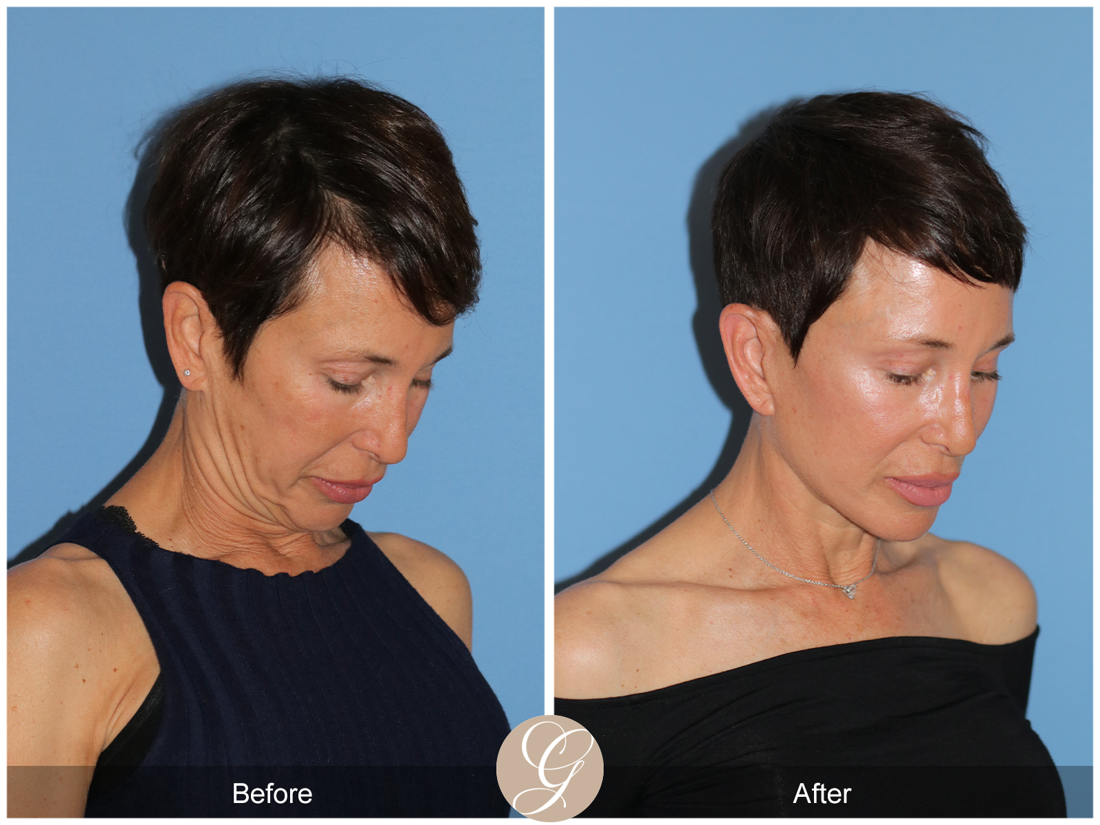 Deep Plane Facelift Case 47 Image