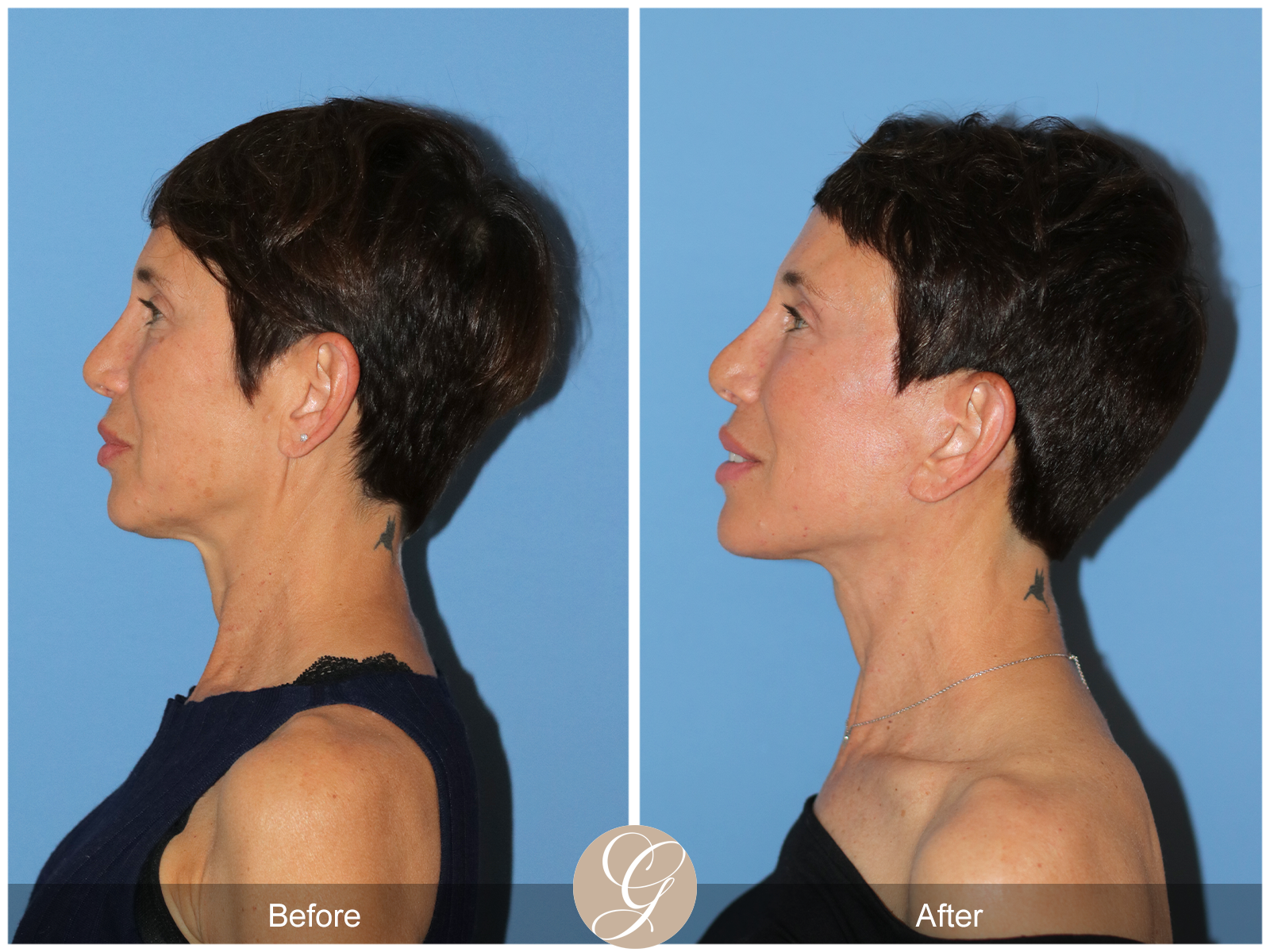 Deep Plane Facelift Case 47 Image