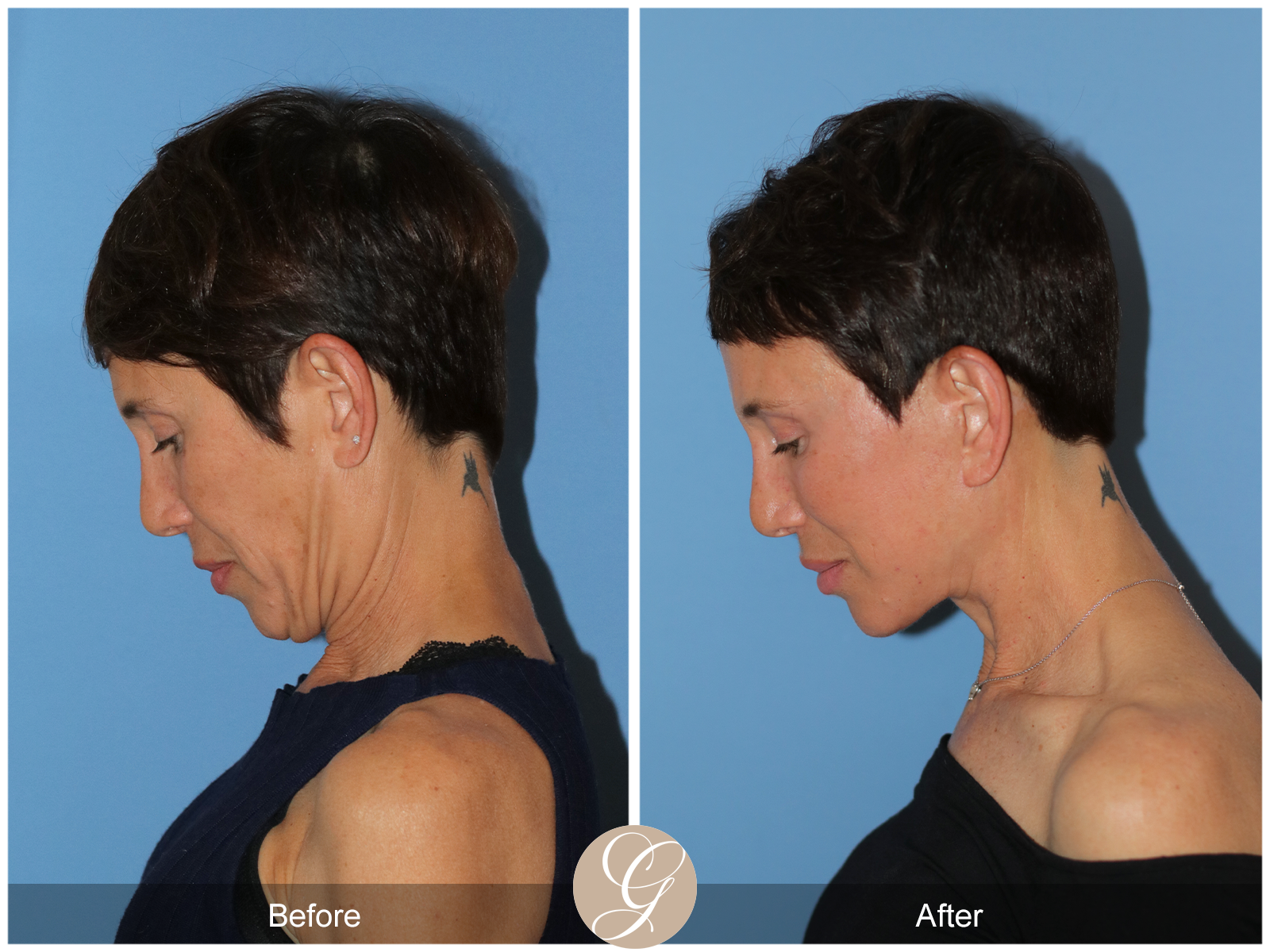 Deep Plane Facelift Case 47 Image