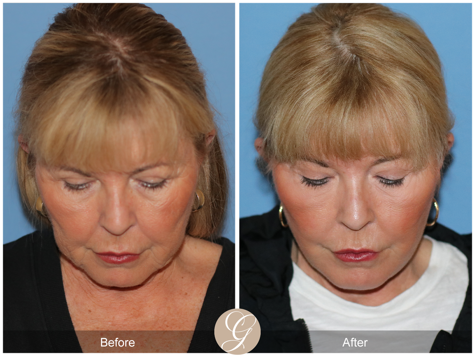 Preservation Deep Plane Facelift Case 35 Image