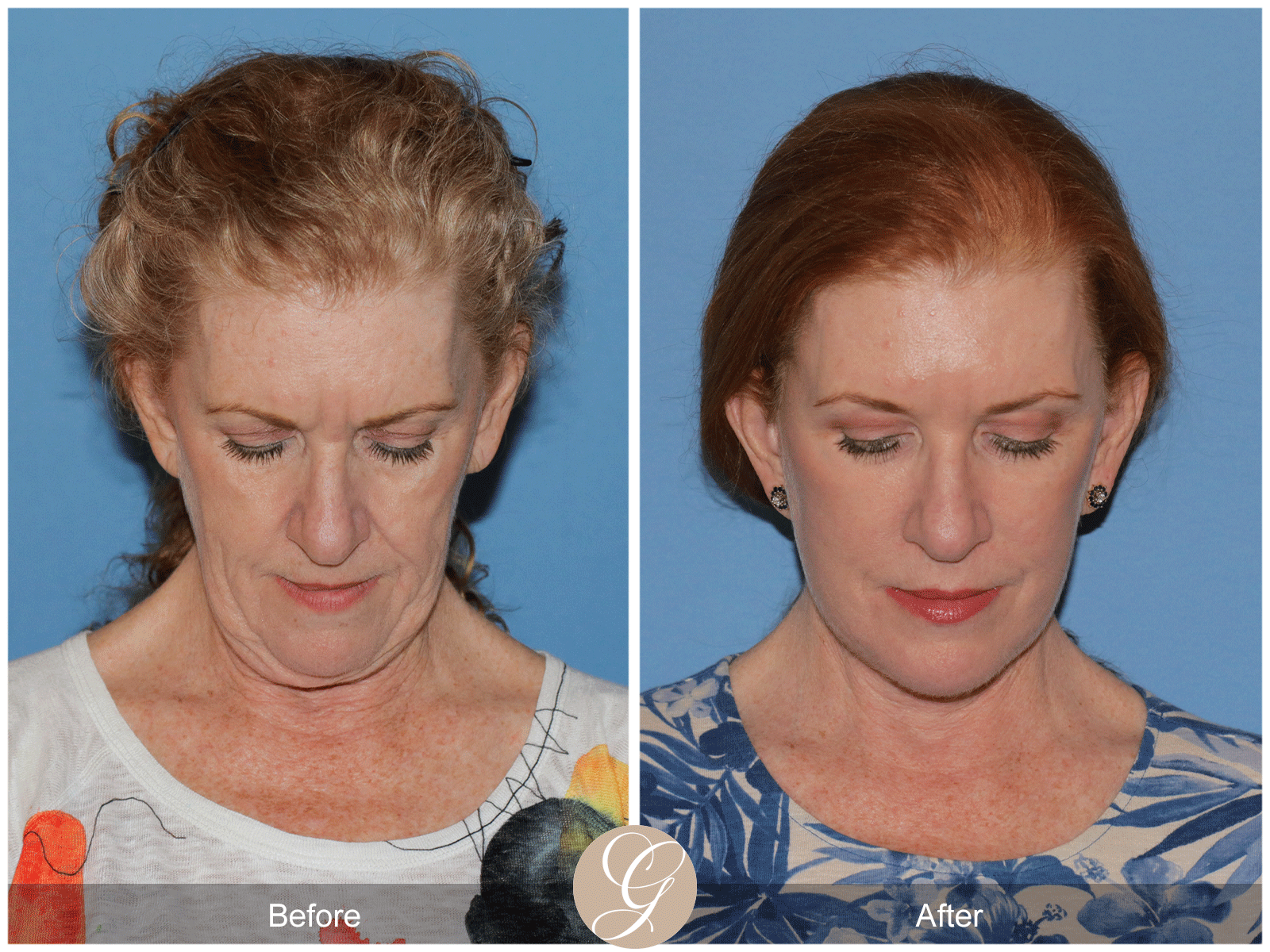 Deep Plane Facelift Case 30 Image