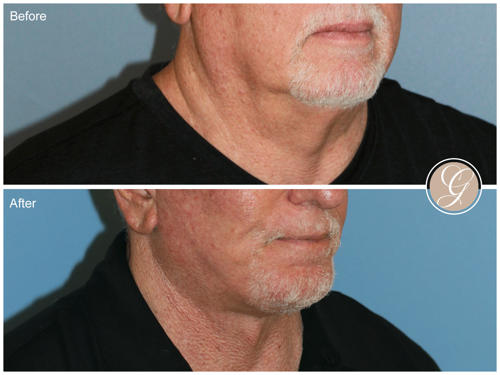 Preservation Deep Plane Facelift Case 50 Image