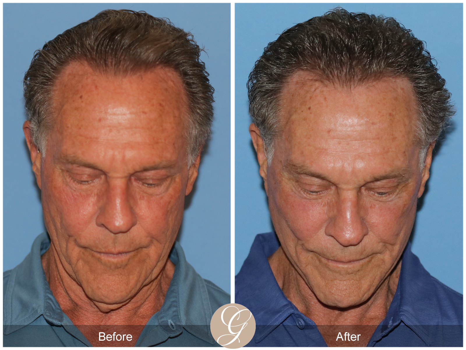 Preservation Deep Plane Facelift Case 36 Image