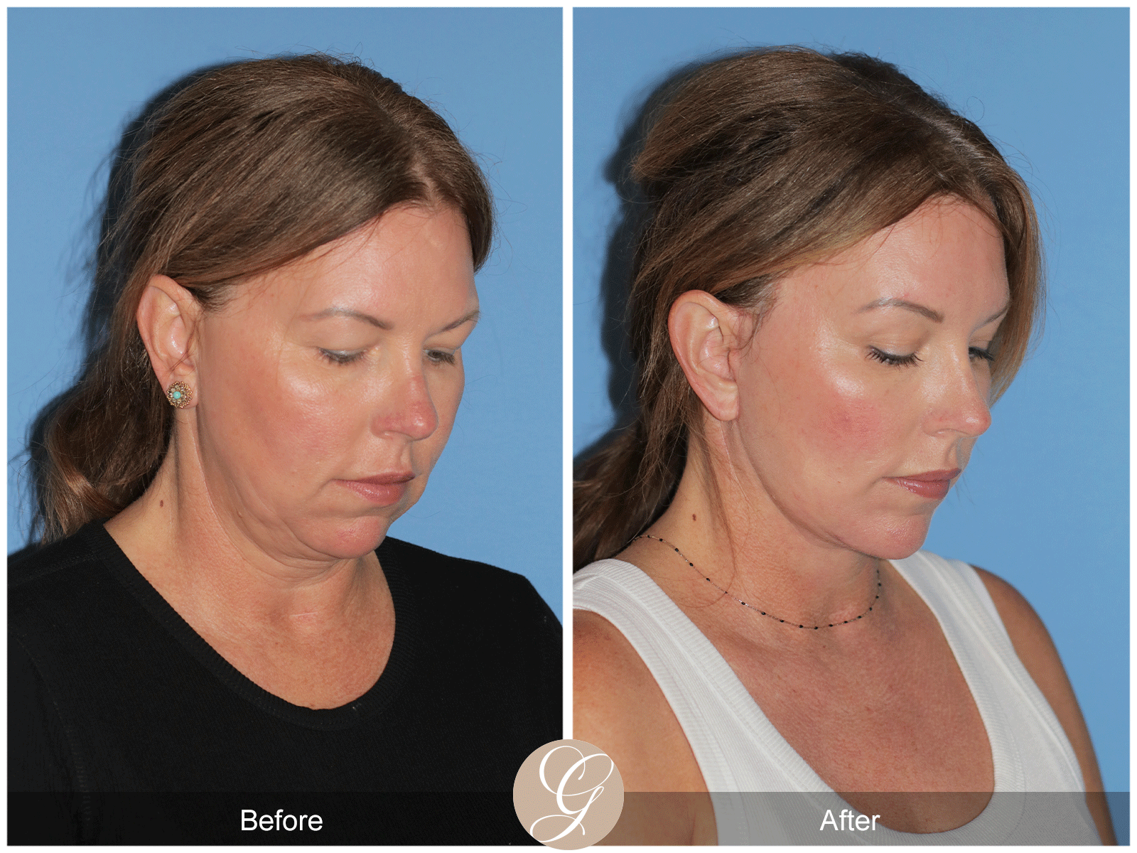 Deep Plane Facelift Case 33 Image