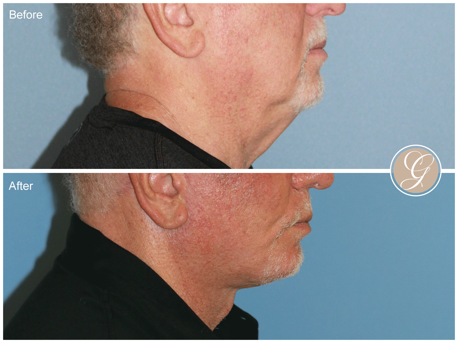 Preservation Deep Plane Facelift Case 50 Image