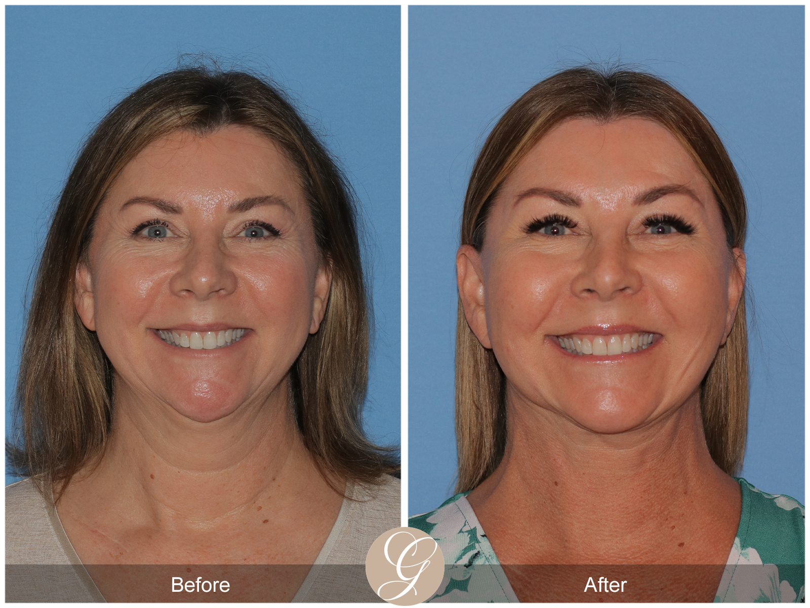 Preservation Deep Plane Facelift Case 37 Image