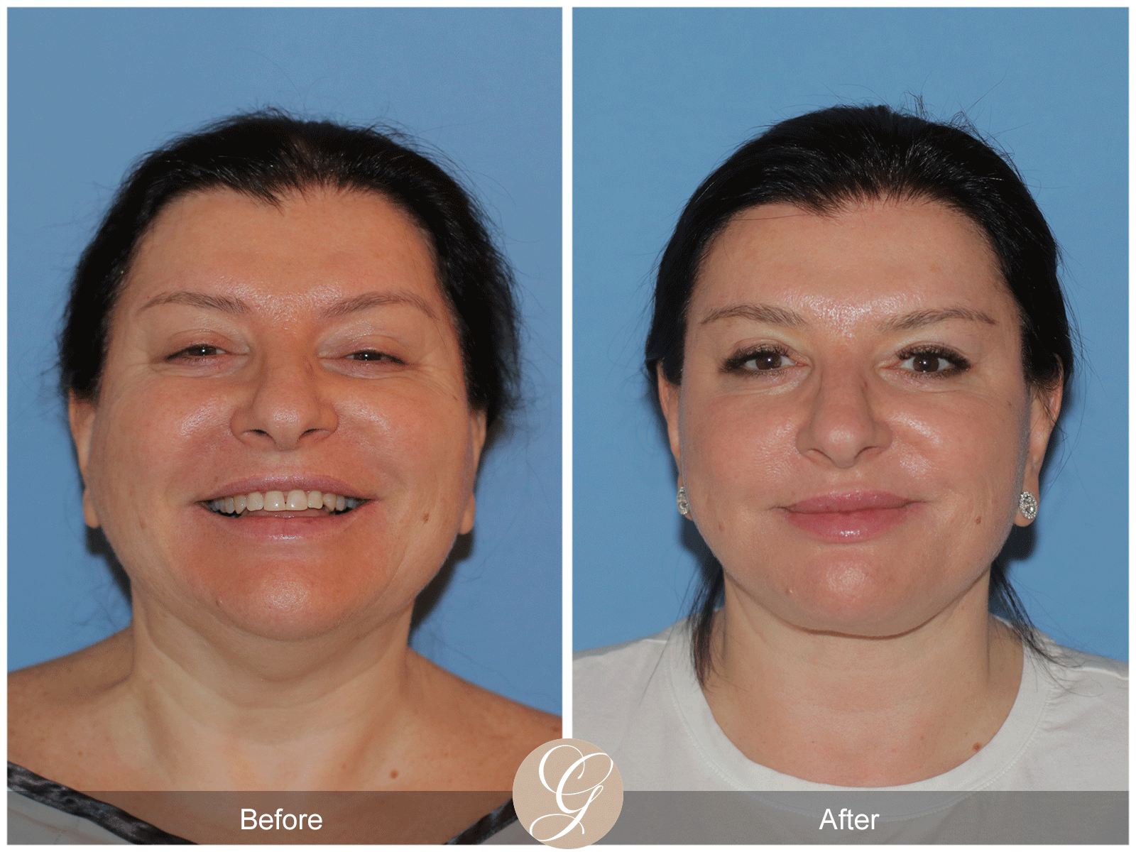 Preservation Deep Plane Facelift Case 40 Image