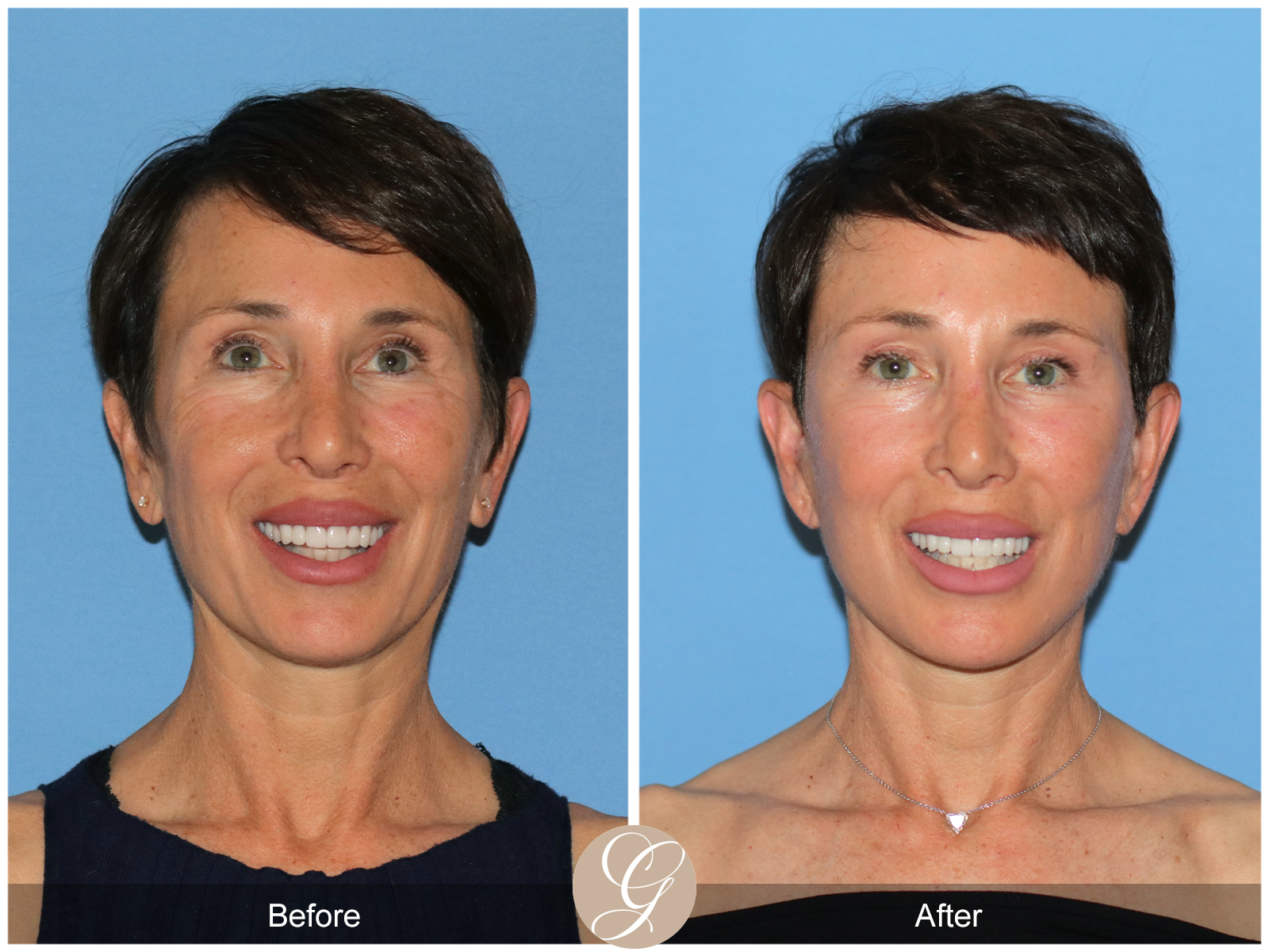Deep Plane Facelift Case 47 Image