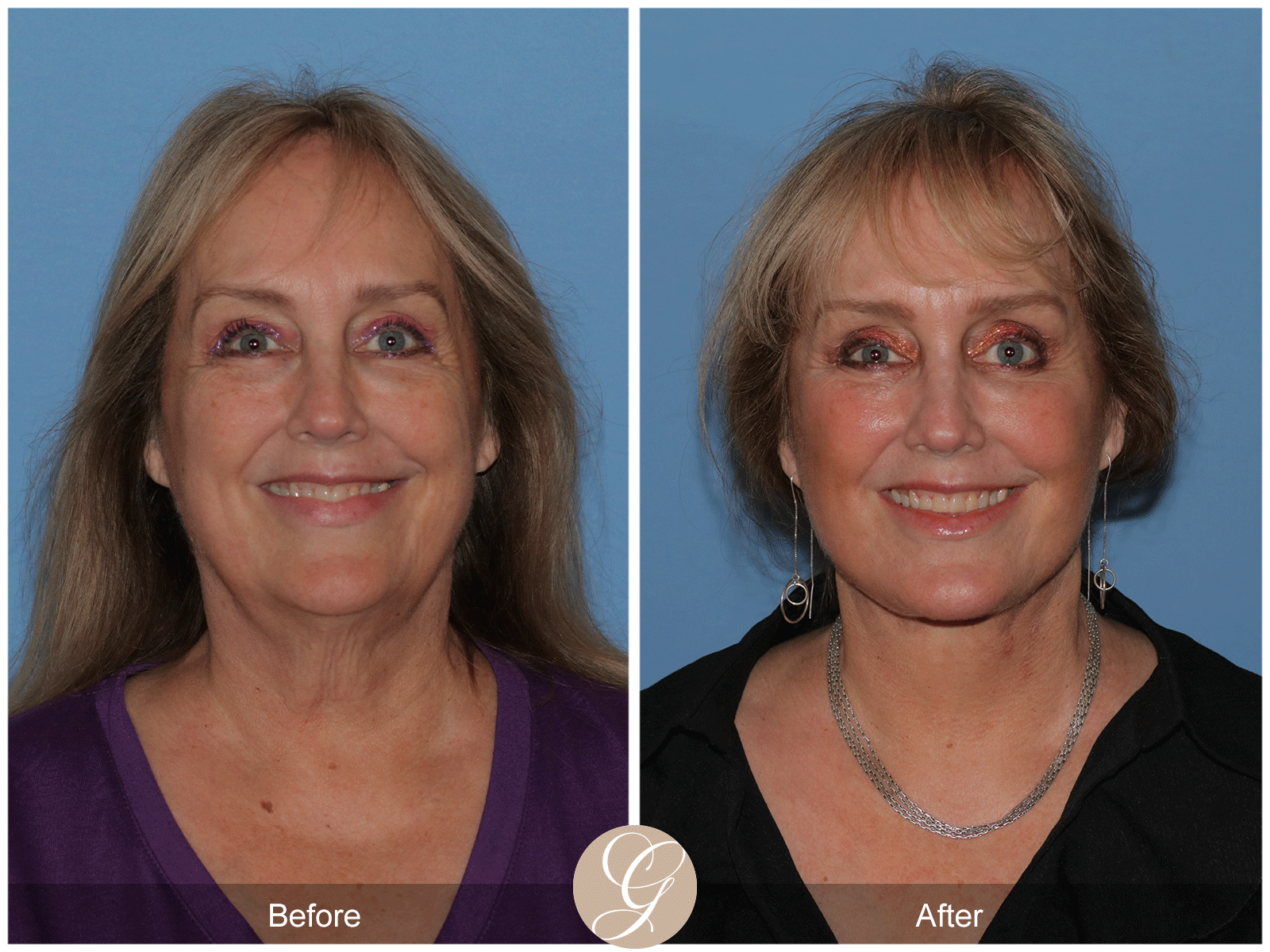 Deep Plane Facelift Case 48 Image
