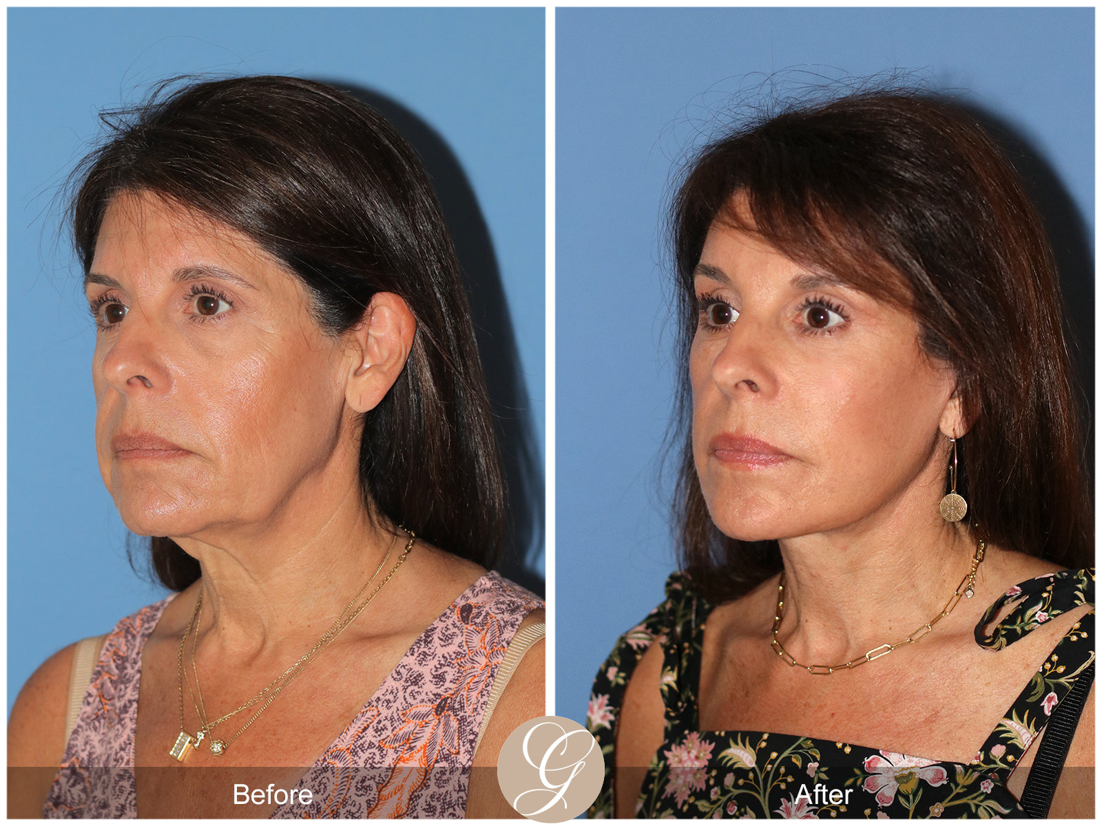 Deep Plane Facelift Case 32 Image