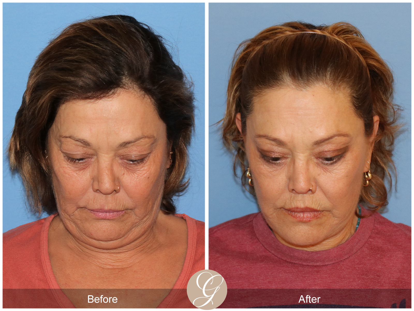 Deep Plane Facelift Case 37 Image