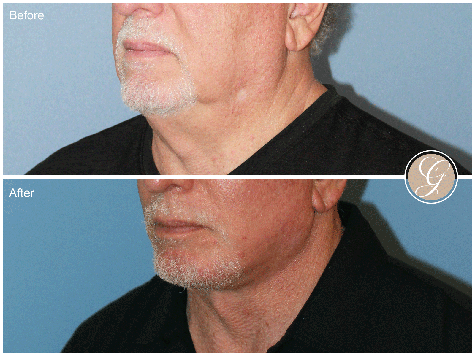 Preservation Deep Plane Facelift Case 50 Image