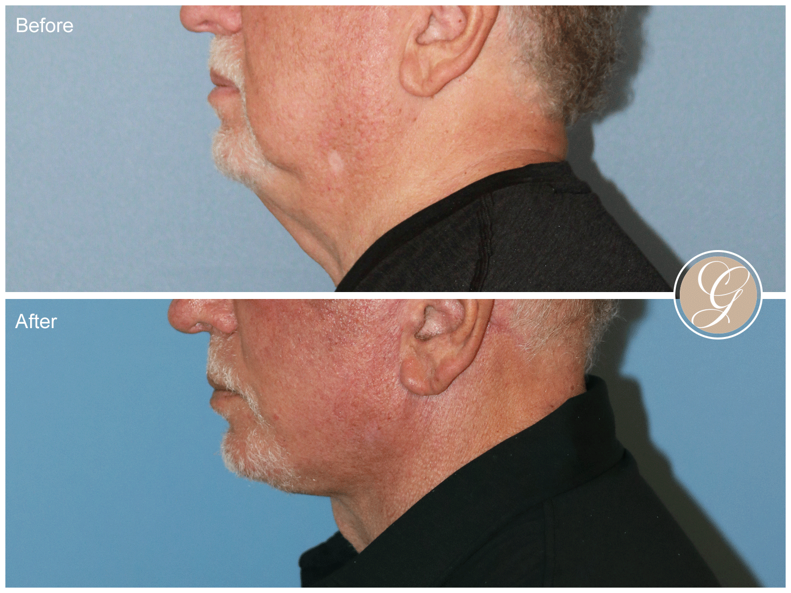 Preservation Deep Plane Facelift Case 50 Image