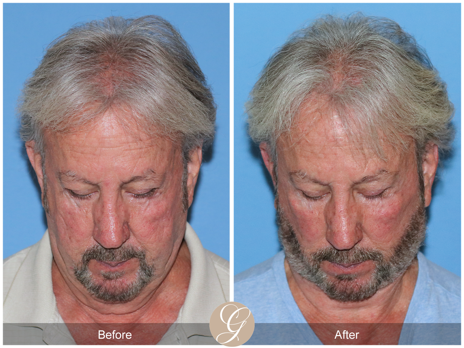 Deep Plane Facelift Case 29 Image