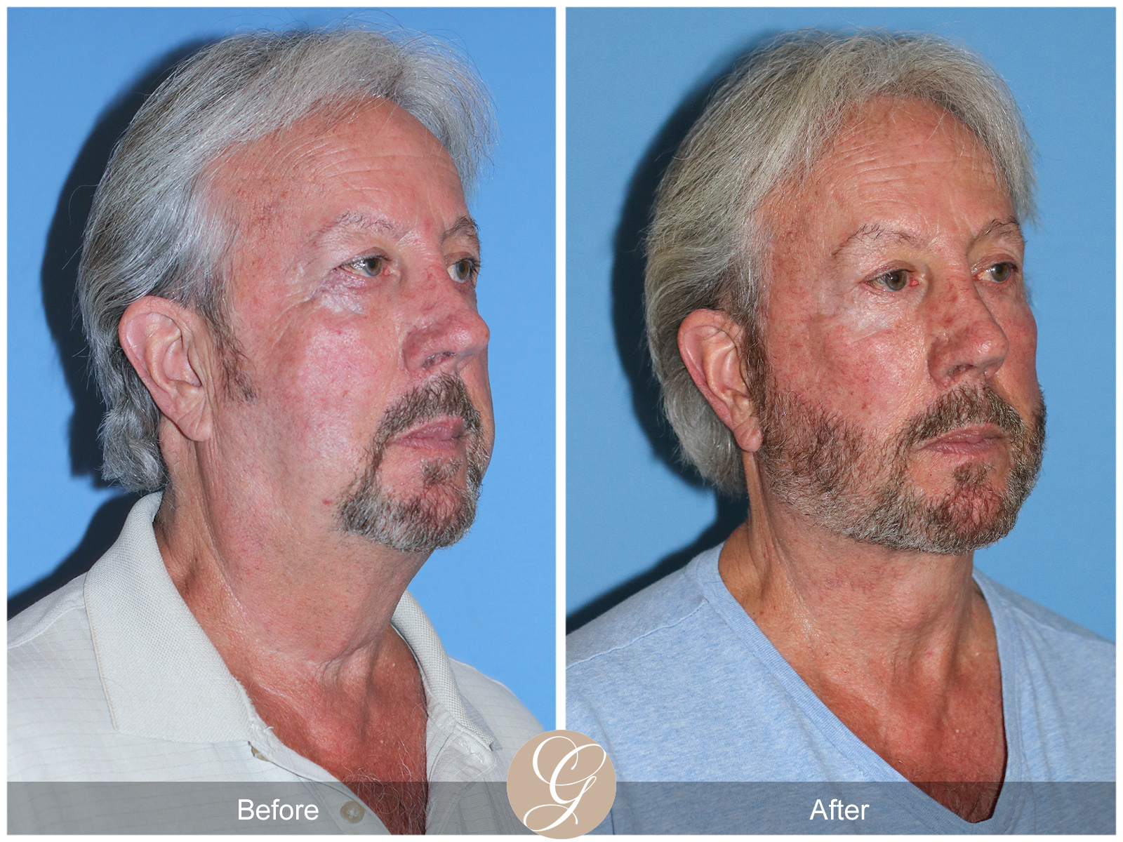 Deep Plane Facelift Case 29 Image