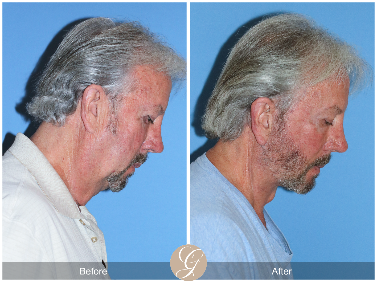 Deep Plane Facelift Case 29 Image