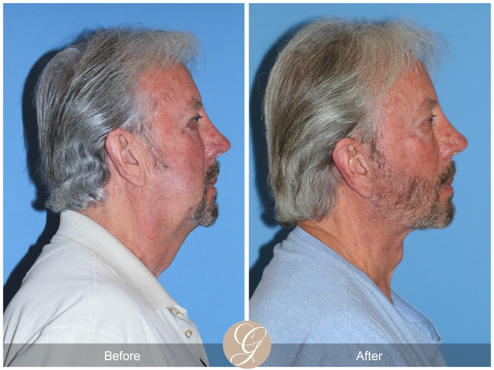 Deep Plane Facelift Case 29 Image