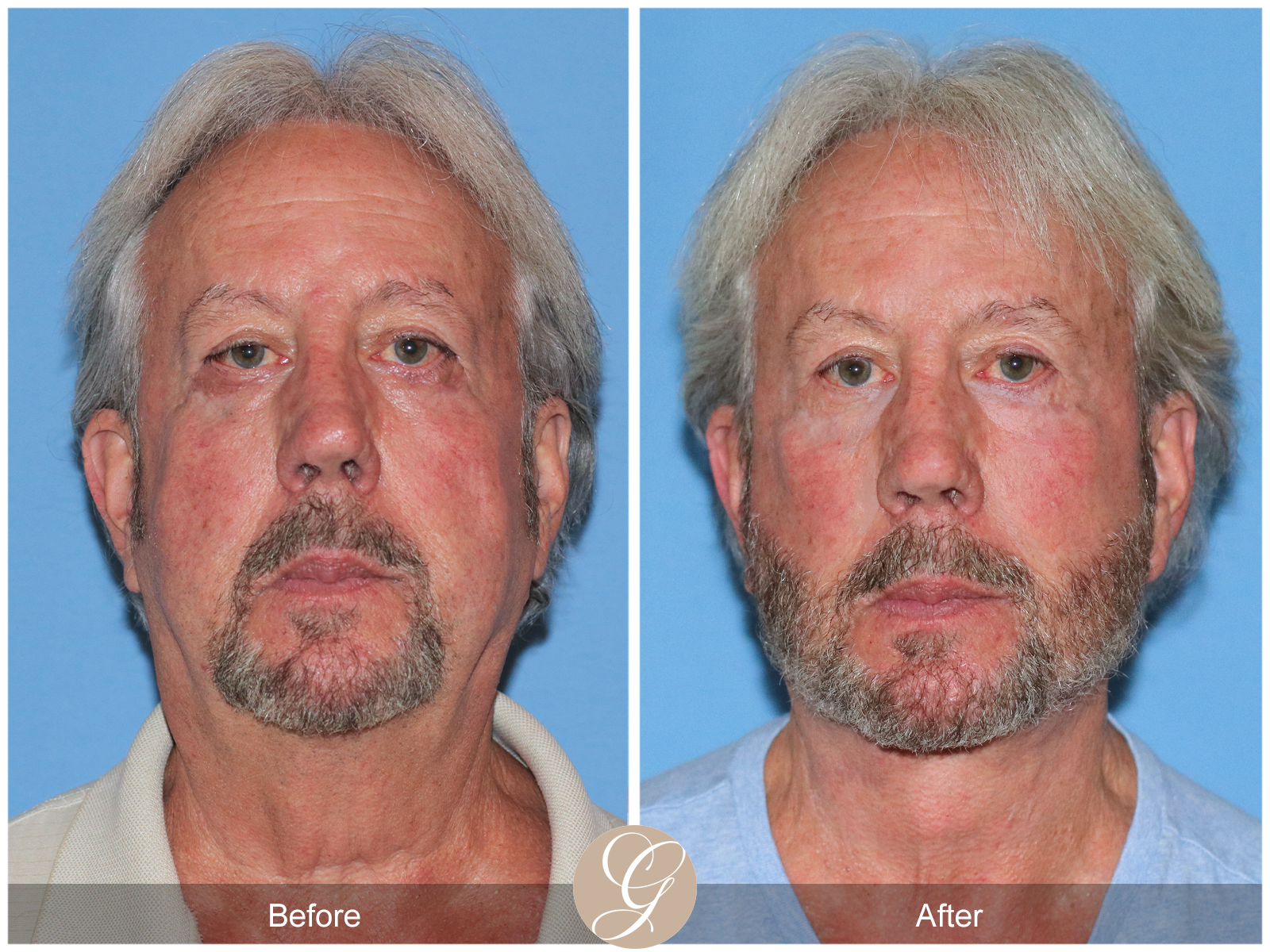 Deep Plane Facelift Case 29 Image