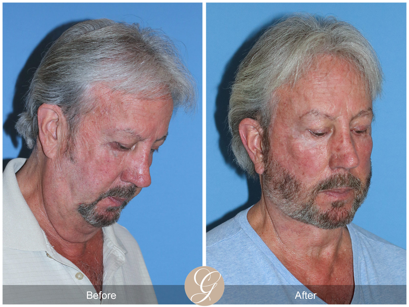 Deep Plane Facelift Case 29 Image