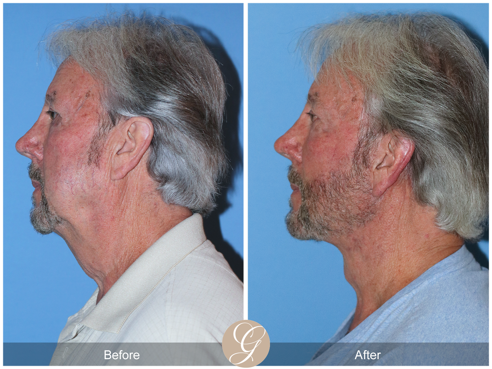 Deep Plane Facelift Case 29 Image