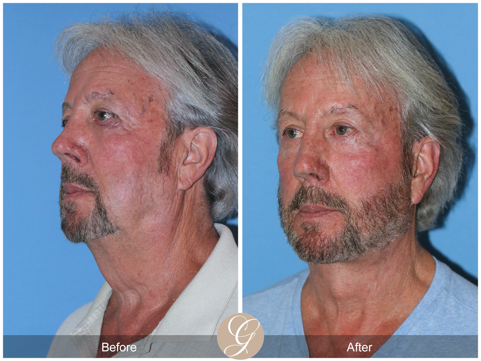 Deep Plane Facelift Case 29 Image