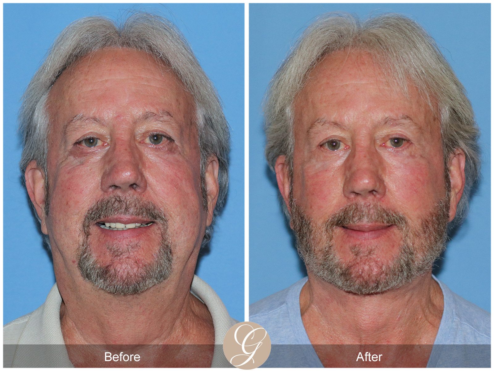 Deep Plane Facelift Case 29 Image