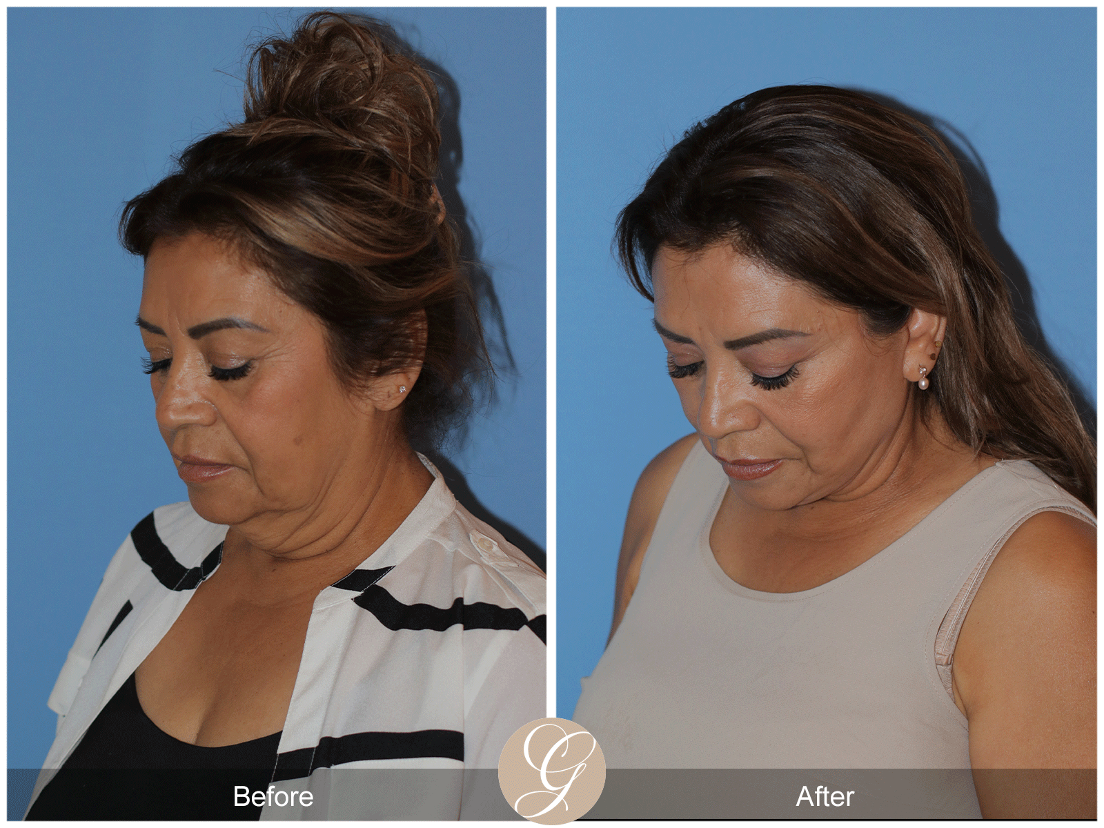 Preservation Deep Plane Facelift Case 41 Image