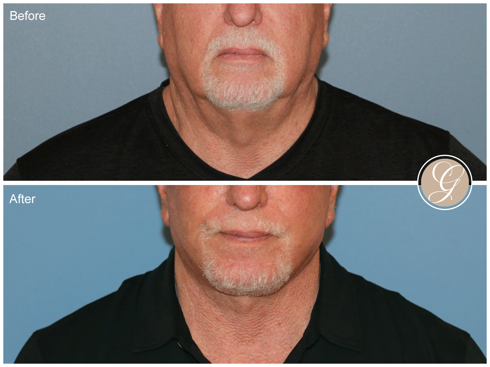 Preservation Deep Plane Facelift Case 50 Image