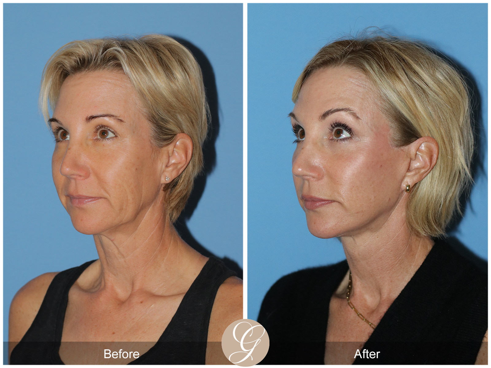 Deep Plane Facelift Case 31 Image