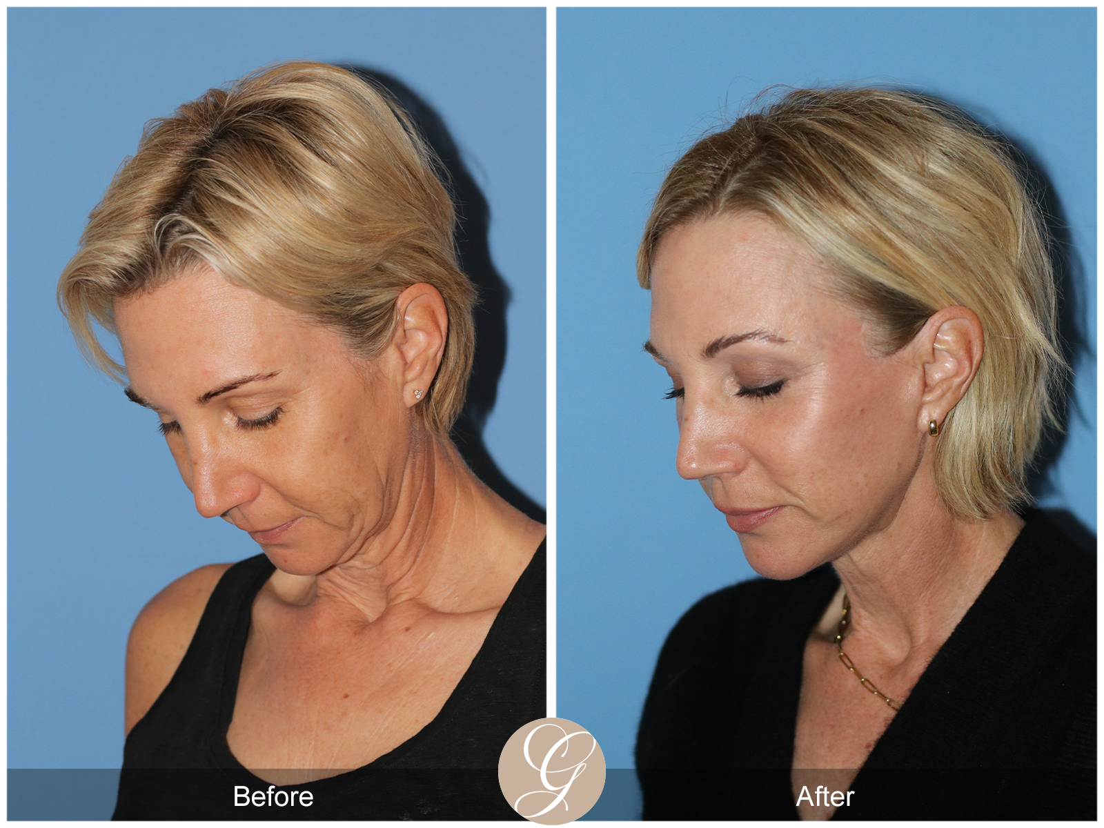 Deep Plane Facelift Case 31 Image