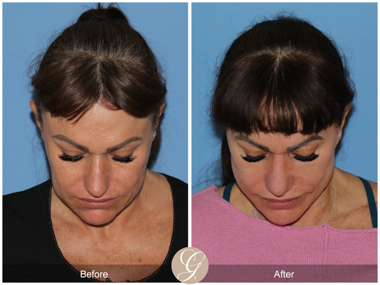 Preservation Deep Plane Facelift Case 47 Image
