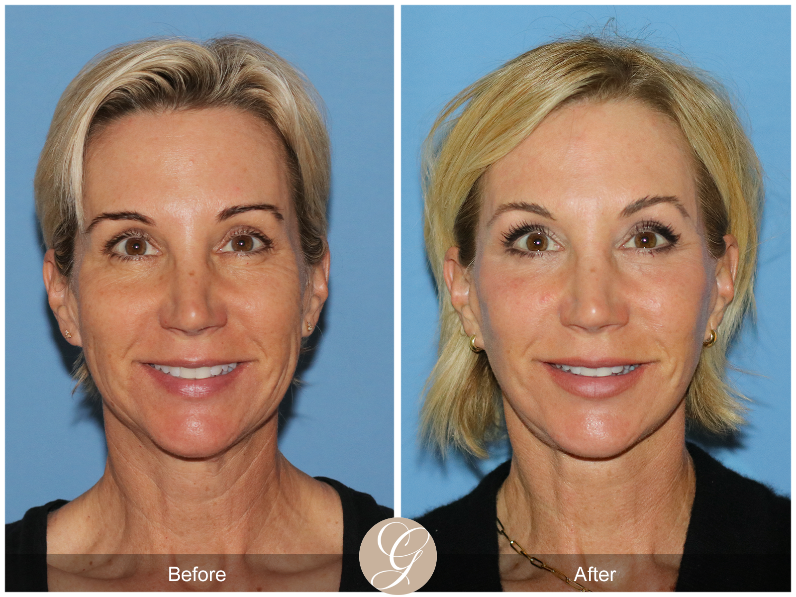 Deep Plane Facelift Case 31 Image