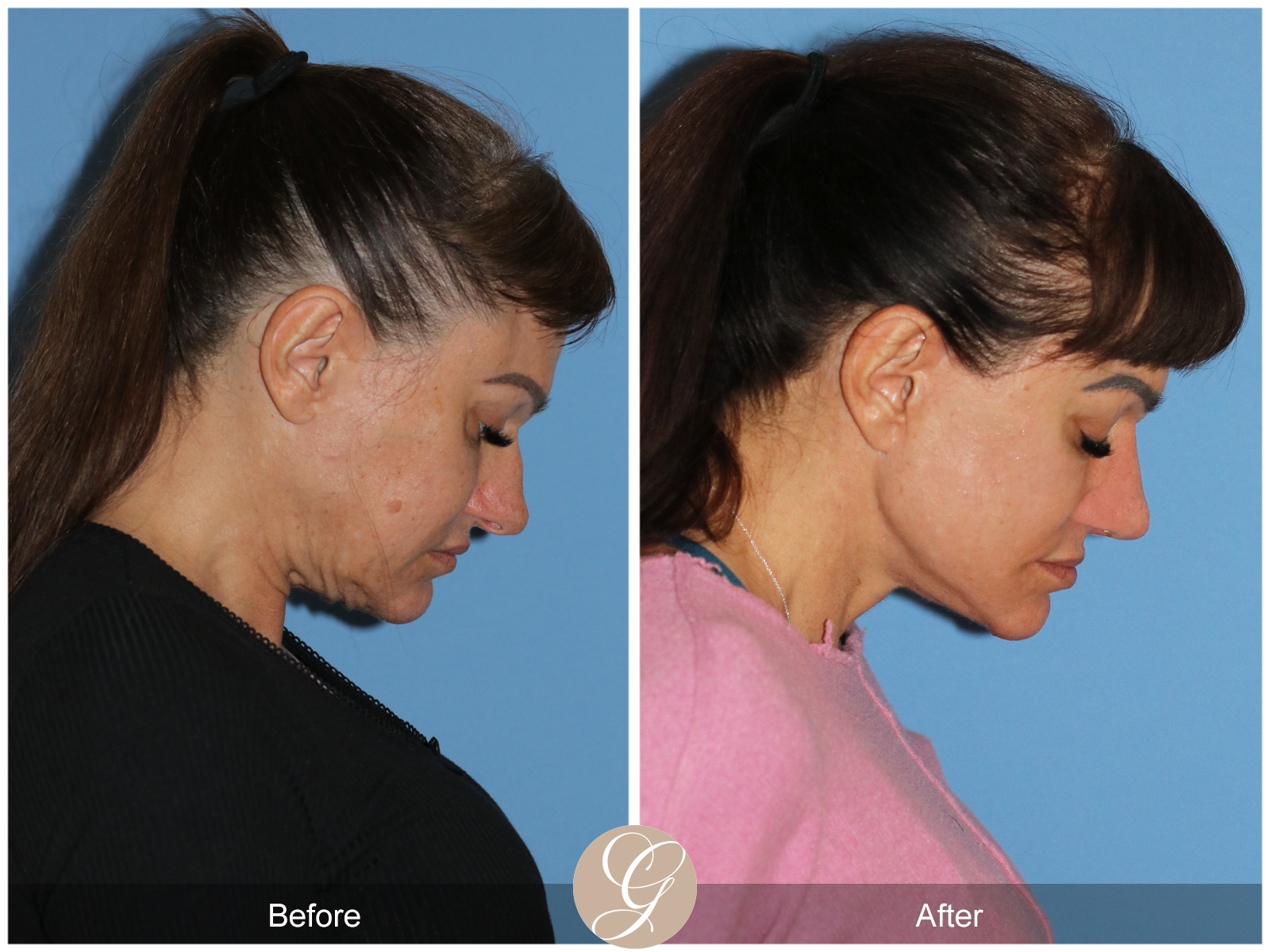 Preservation Deep Plane Facelift Case 47 Image