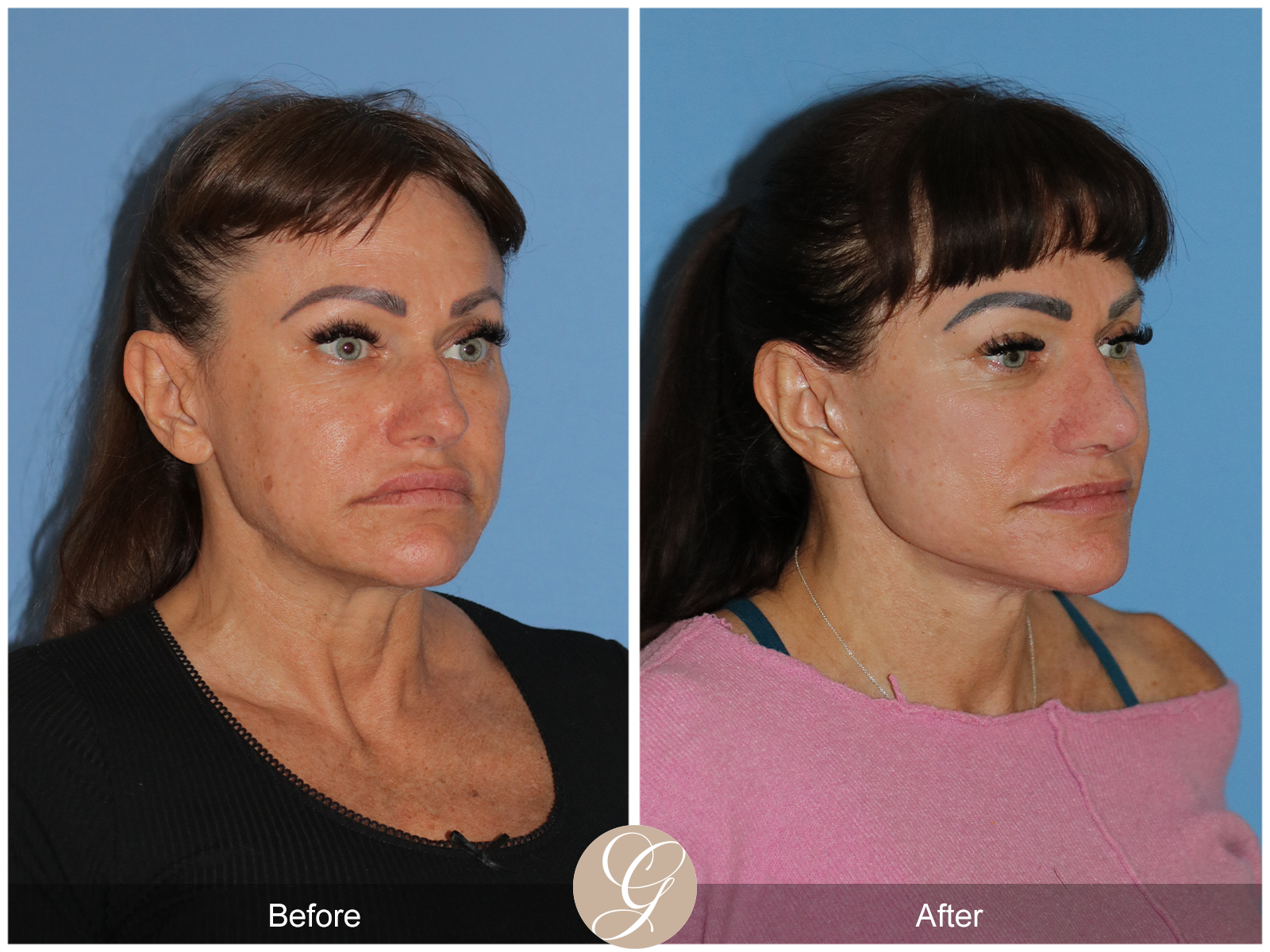 Preservation Deep Plane Facelift Case 47 Image