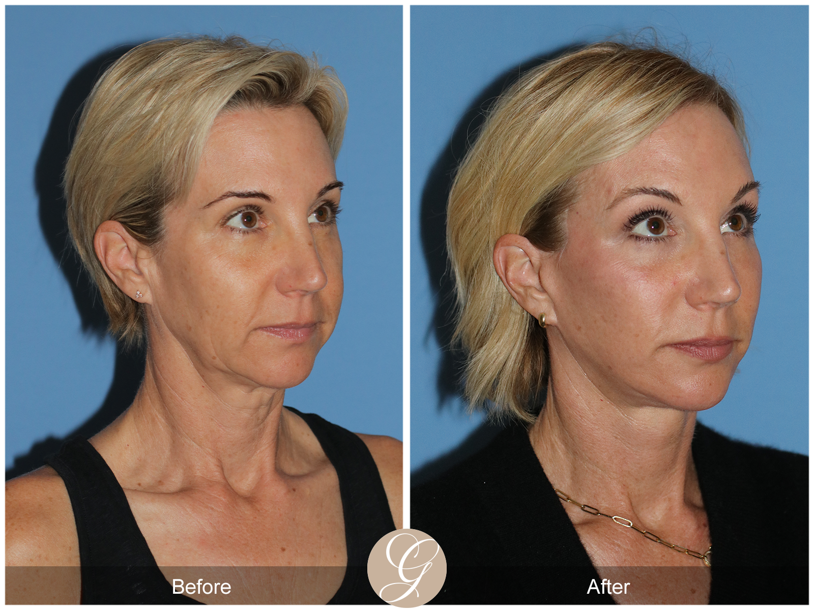 Deep Plane Facelift Case 31 Image