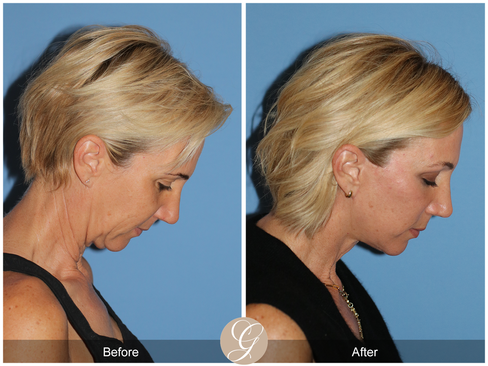 Deep Plane Facelift Case 31 Image