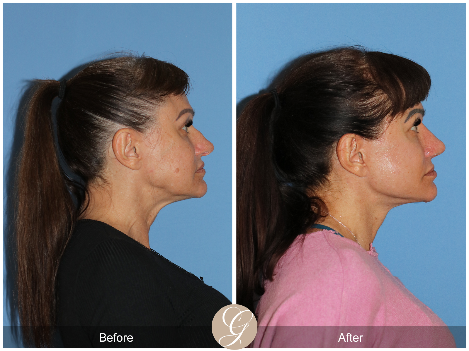 Preservation Deep Plane Facelift Case 47 Image