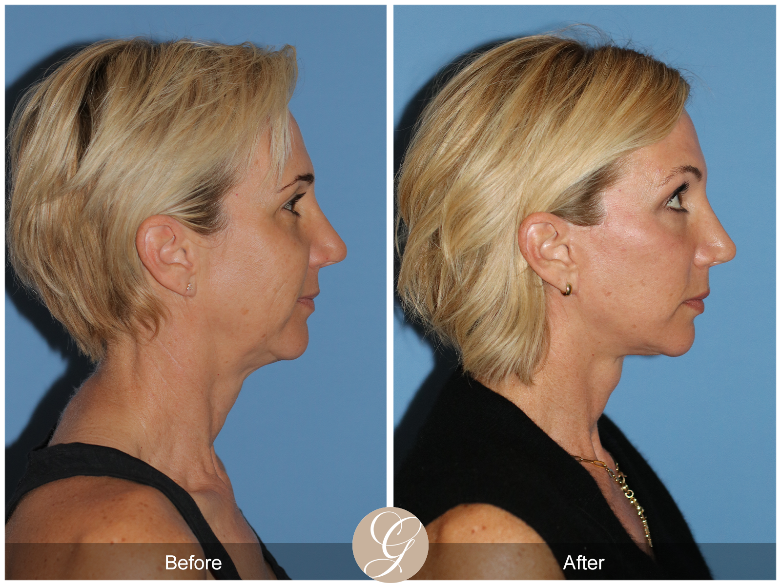 Deep Plane Facelift Case 31 Image