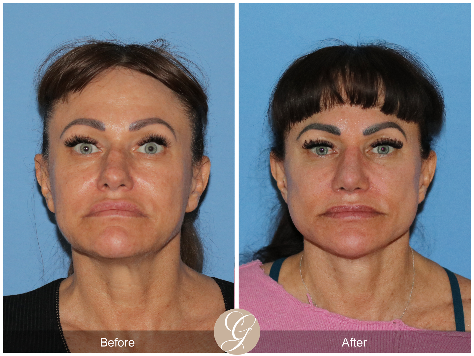 Preservation Deep Plane Facelift Case 47 Image