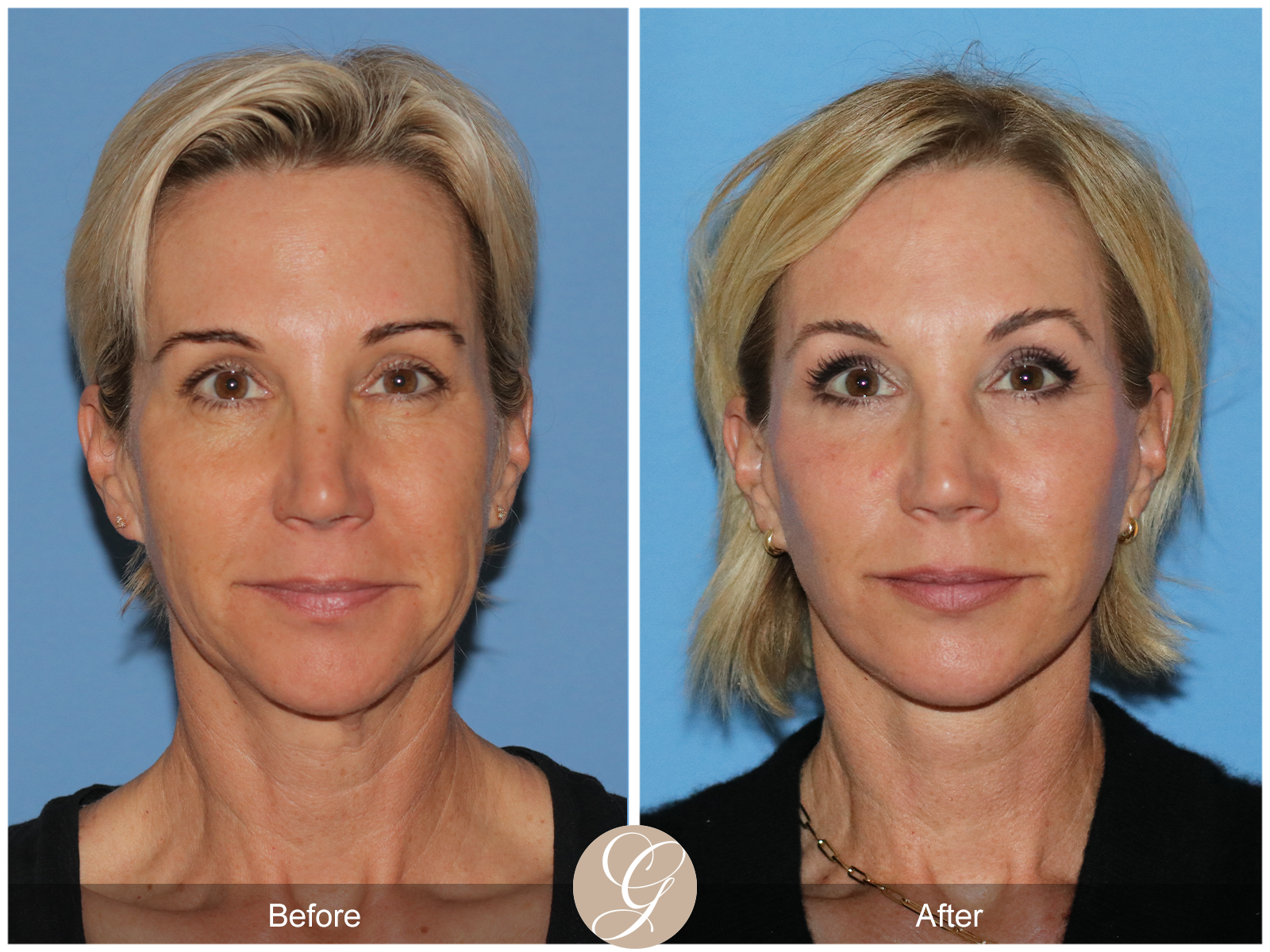 Deep Plane Facelift Case 31 Image