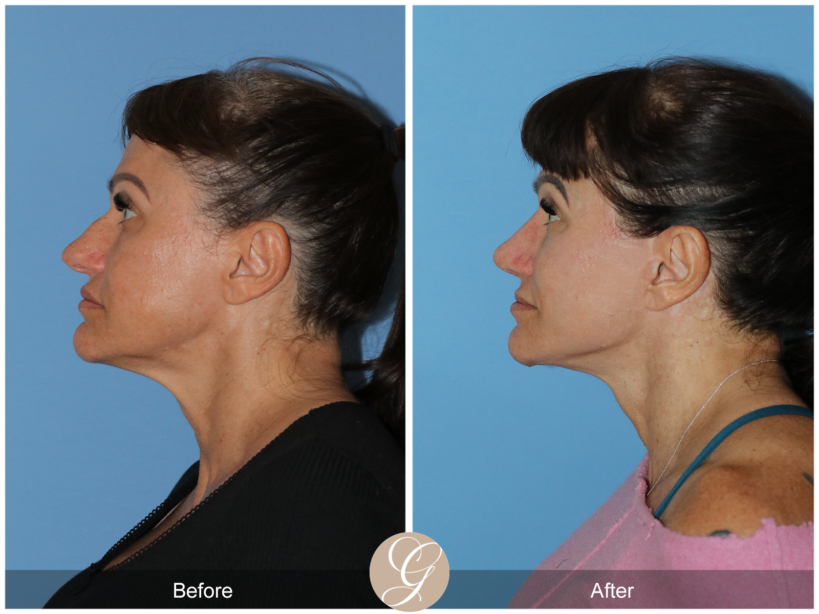 Preservation Deep Plane Facelift Case 47 Image